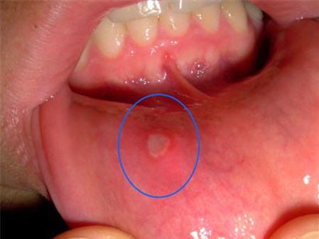 Chữa nhiệt miệng hiệu quả với bột sắn dây