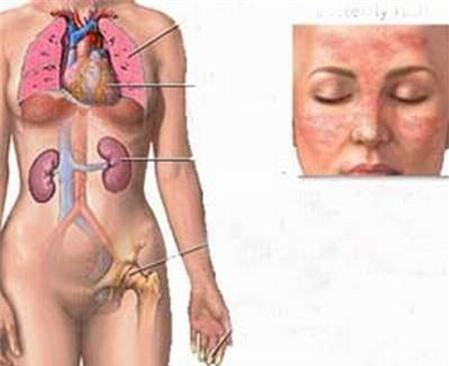 Thuốc trị bệnh thận luput