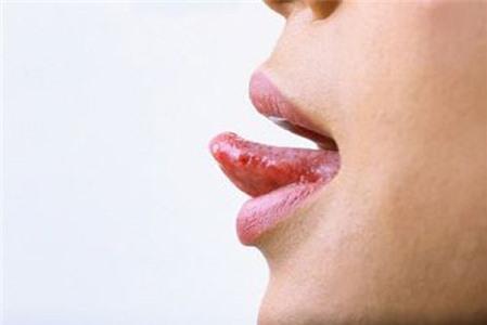 Lưỡi rát là bệnh gì?