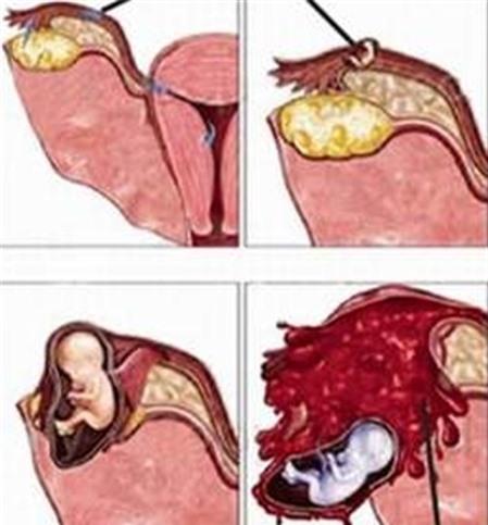 Dấu hiệu chửa ngoài dạ con
