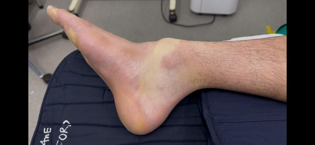 Chấn thương mắt cá chân pickleball