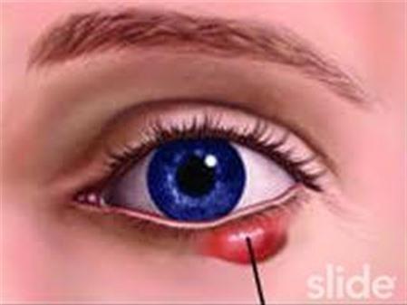 Cách xử lí khi lẹo mắt tự vỡ, AloBacsi ơi?